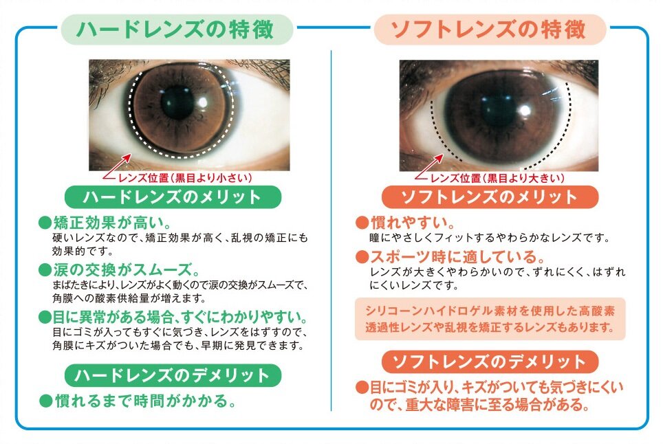 コンタクトレンズについて｜Menicon Miru 大阪上本町店